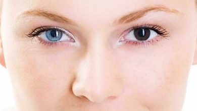 เฮเทอโรโครเมีย, ดวงตาที่มีสีต่างกัน: นี่คืออะไร, สาเหตุ, อาการ, การวินิจฉัย, การรักษา, การป้องกัน - จักษุวิทยา