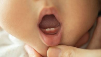 Natal (Medfödd) tänder: vad är detta, orsaker, symptom, diagnostik, behandling, förebyggande