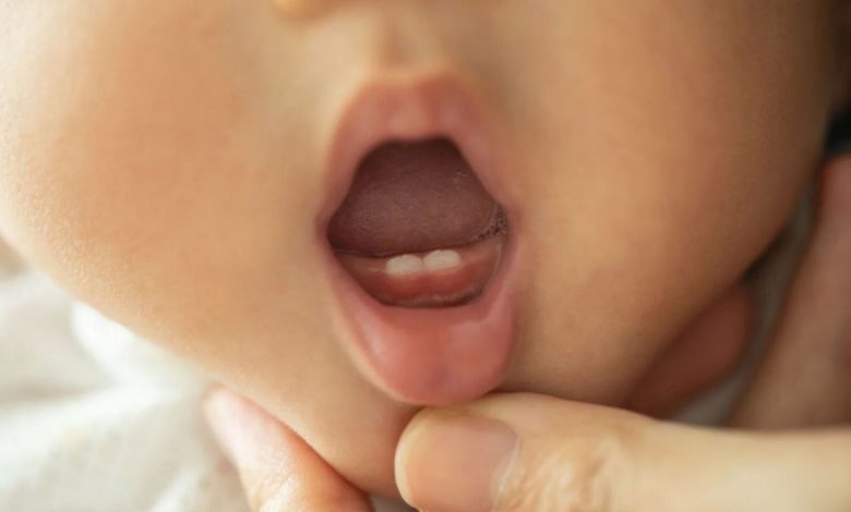 Natal (Congenital) teeth: what is this, causes, symptoms, diagnostics, treatment, prevention