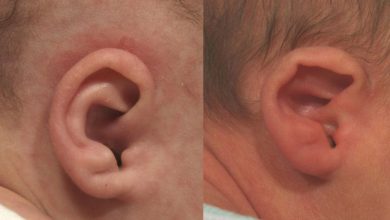 Orejas de implantación baja y anomalías del pabellón auricular: Que es esto, causas, síntomas, diagnóstico, tratamiento, prevención