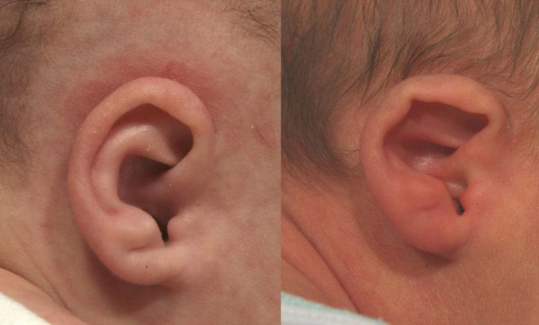 Lavtstillede ører og anomalier i pinna: hvad er dette, årsager, symptomer, diagnostik, behandling, forebyggelse