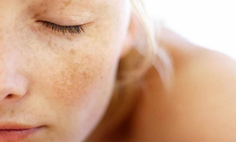 Spots on the skin, dyschromia: What's it, causes, symptoms, diagnostics, treatment, prevention