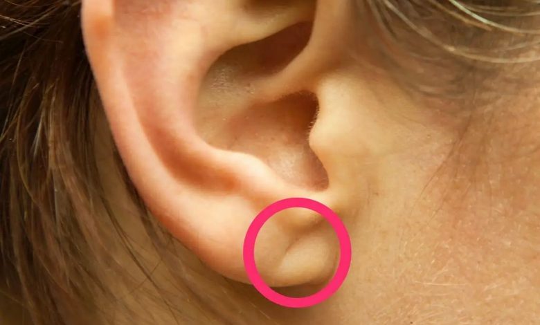 耳垂上的皺紋: 這是什麼, 原因, 症狀, 診斷, 治療, 預防