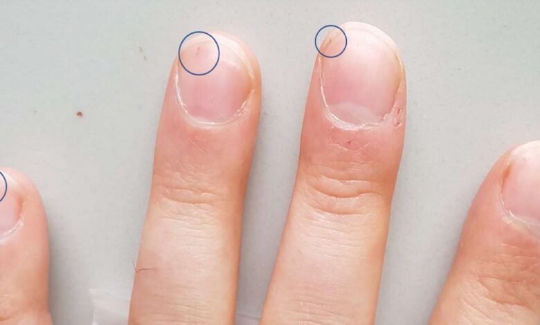 Granaatscherven bloedingen (bloedingen onder de nagels): Wat is het, oorzaken, symptomen, diagnostiek, behandeling, het voorkomen - Bloed onder vingernagels