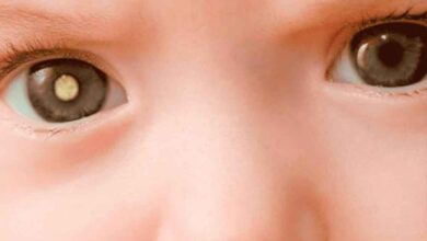 Leukocoria, valkoinen pupillirefleksi: Mikä se on, syyt, oireet, diagnostiikka, hoito, ennaltaehkäisy - Silmä - Oftalmologia