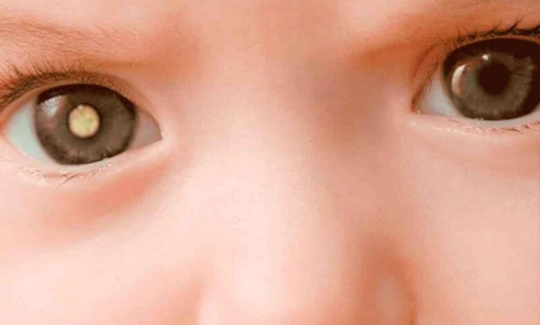 Leukocoria, white pupil reflex: What's it, causes, symptoms, diagnostics, treatment, prevention - Eye - Ophthalmology