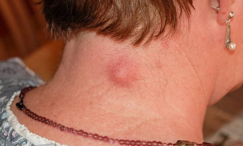Bump on the neck, swelling in the neck: What's it, causes, symptoms, diagnostics, treatment, prevention