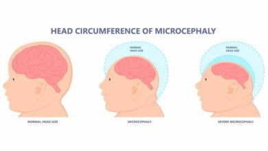 Mikrocefalija: što je, uzroci, simptomi, dijagnostika, liječenje, prevencija - Predsjednik, lubanja