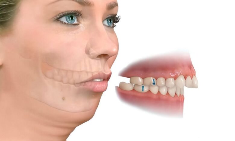 Micrognathia, abnormally small jaw: What's it, causes, symptoms, diagnostics, treatment, prevention - Chairman, skull