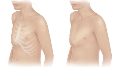 Καρίνα στήθος, Στήθος περιστεριού στους ανθρώπους (Καράβι στήθους): Τι είναι, αίτια, συμπτώματα, Διάγνωση, θεραπεία, πρόληψη