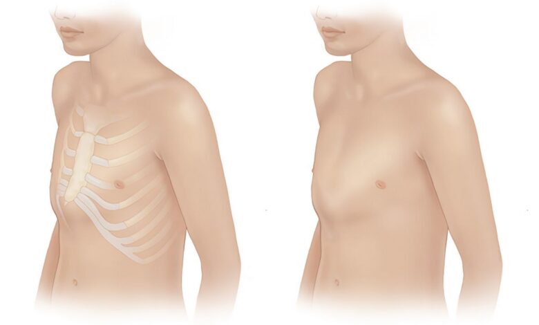 الصدر المقلوب, صدر الحمام في البشر (سفينة الثدي): ما هذا, الأسباب, الأعراض, التشخيص, علاج, منع