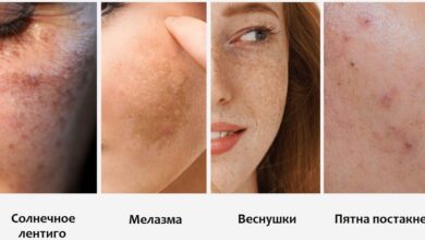 皮膚の斑点: それはなんですか, 原因, 症状, 診断法, 治療, 予防