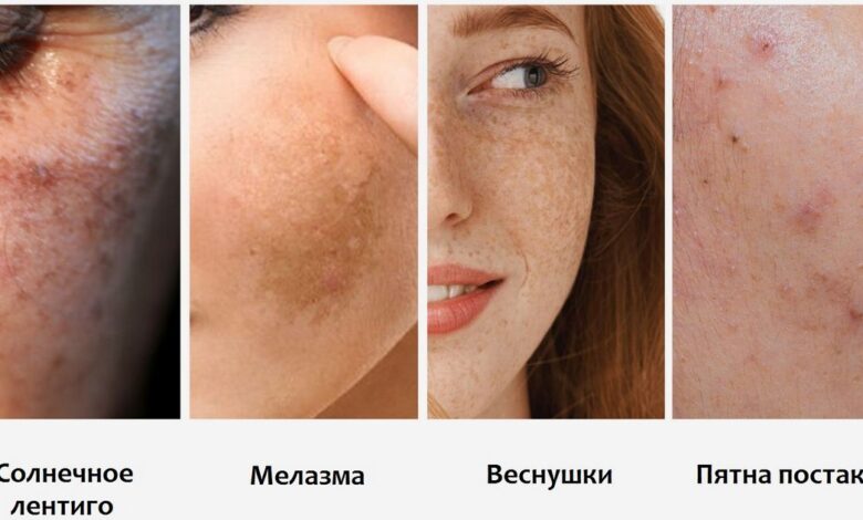 Mrlje na koži: što je, uzroci, simptomi, dijagnostika, liječenje, prevencija