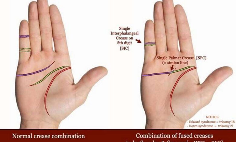 Line simian, single transverse palmar crease: What's it, causes, symptoms, diagnostics, treatment, prevention - Brush, hand